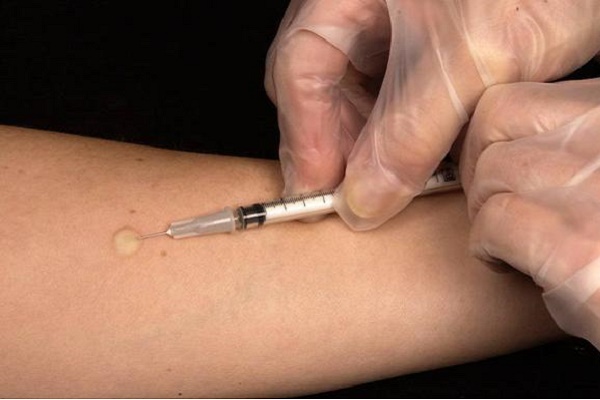 Un 88,7% del total de pacientes con tuberculosis en la Comunitat Valenciana completa con éxito los tratamientos